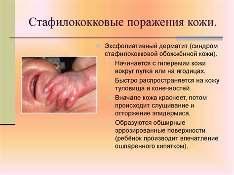Гнойно-септические заболевания новорождённых - презентация онлайн