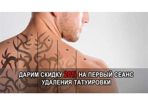 УДАЛЕНИЕ ТАТУИРОВОК без ожогов и шрамов – выведение тату лазером в ...