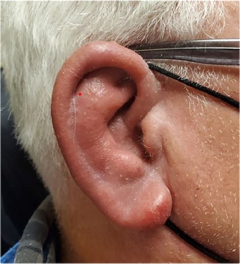 swollen ear green discharge  timothy mitchell blog