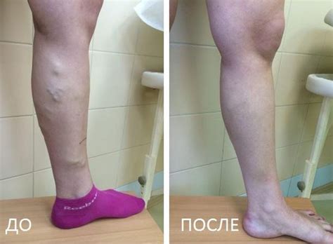 Профессиональное лечение тромбофлебита в Киеве | Хирургия №2