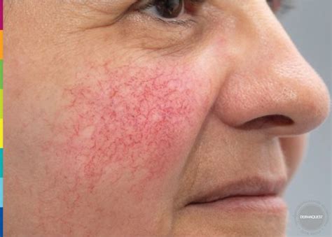 DERMAQUEST »Виды розацеа| Статьи | Отзывы | Купить