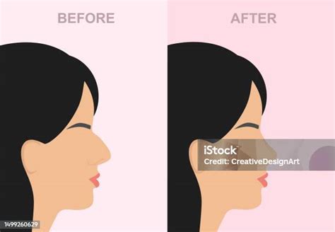 Side View Of Womans Face With Before And After Rhinoplasty Stock ...