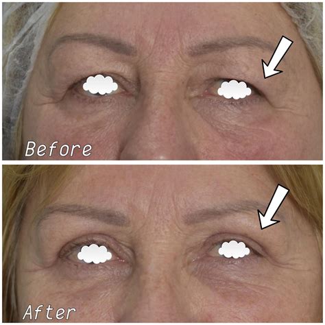 Blepharoplasty: eyelid surgery, price, before and after, cost UK, NHS