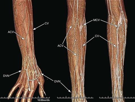 Median Cubital Vein Model - Clinical Anatomy Operative Surgery Cubital ...