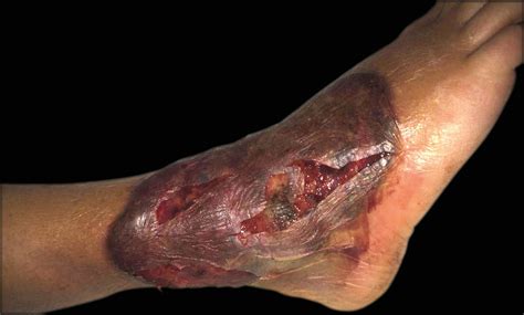 Bullous pyoderma gangrenosum as a predictor of hematological ...