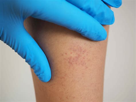 La Leucemia Se Contagia Por Besos 8