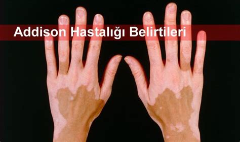 Addison Hastalığı Nedir ? Addison Belirtileri | Soru Laboratuvarı