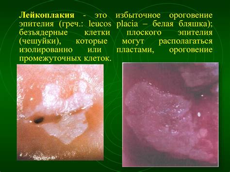 Опухоли женских половых органов - online presentation