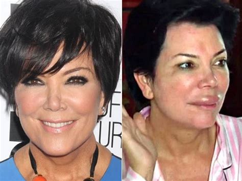 Kris Jenner’s Before and After Plastic Surgery Photos Show She Looks