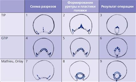 Гипоспадия у детей