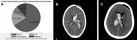 intraventricular hemorrhage neurosurgery blog