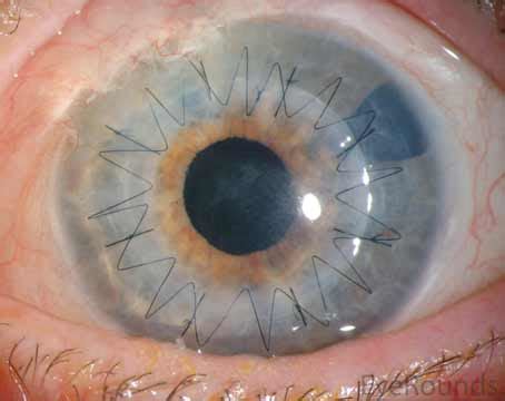 Cornea