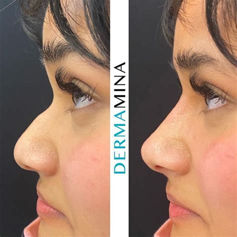 Non Surgical Rhinoplasty, Nose Job in London · Dermamina