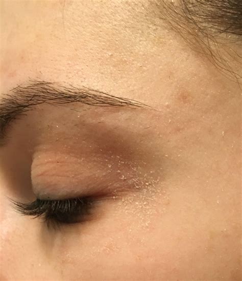 [misc] Recommendations for dry flaky skin around eyes | Dry skin around