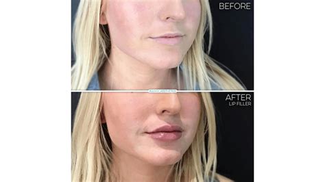 juvederm    visual evidence medical spa rx