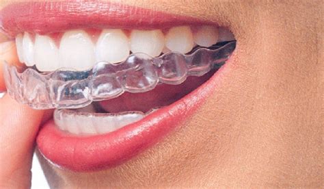 clear aligner information  cosmetic dentistry