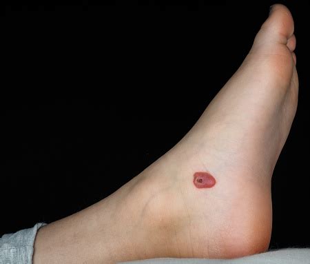 Bolha De Sangue No Pé