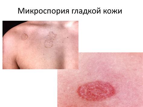 Грибковые заболевания кожи. Дерматофитии: трихофития, микроспория ...
