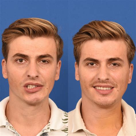 Facial Paralysis - CENTER for Advanced Facial Plastic Surgery