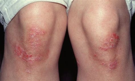 Different types of psoriasis and their proper diagnosis - ExHealth