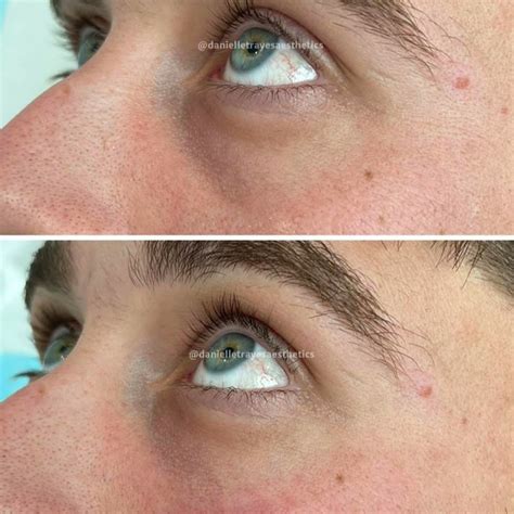 Eye Treatments - Rejuvenate Laser & Skin Clinic