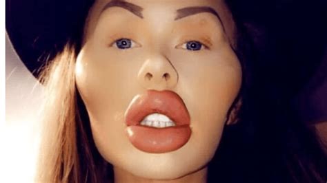 I was addicted to fillers - friends can't recognise me now I've had it ...