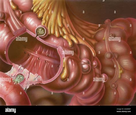 With diverticulitis hi-res stock photography and images - Alamy