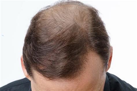 ExtraHair - шампунь и сыворотка для волос ExtraHair®