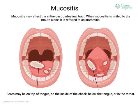 S6E22: Mucositis with Cancer Treatment: What it is and How You can