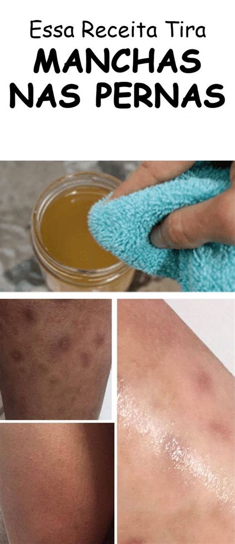 O Que Fazer Para Tirar Manchas Escuras Nas Nadegas - Receita caseira para clarear a virilha sem sair de casa | Manchas ...