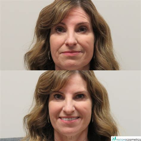 Wrinkle Relaxers – Restore Cosmetics