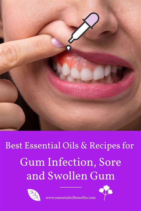 how to get rid of gum abscess fast - jillesdotcom