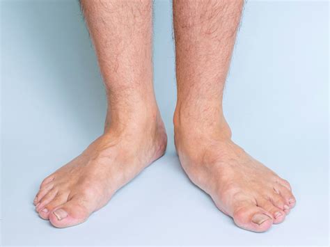 Flat Feet Symptoms: How to Tell If You Have Flat Feet | CLS Health