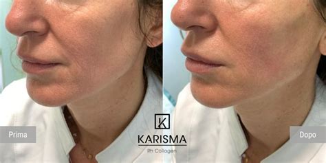 KARISMA - Softfiller biorestitutivo | Rh Collagen