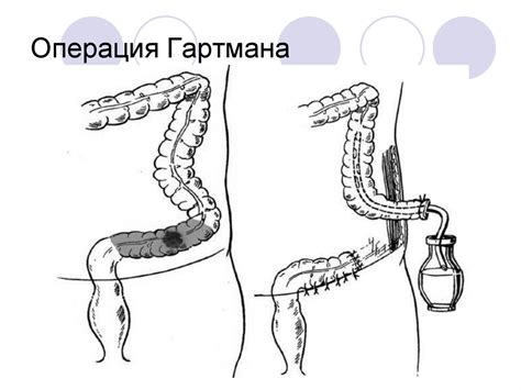 Колоректальный рак. Хирургическое лечение - online presentation