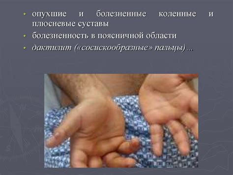 Реактивный артрит - презентация онлайн