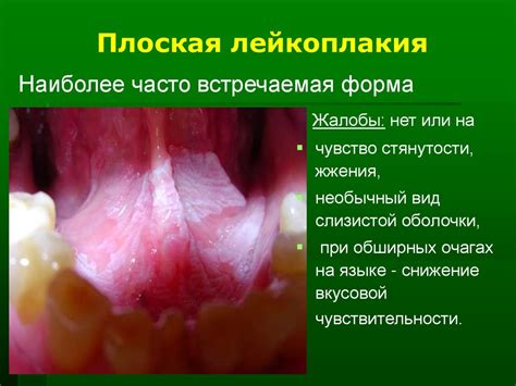 Лейкоплакия. Лекция для студентов 5 курса - презентация онлайн