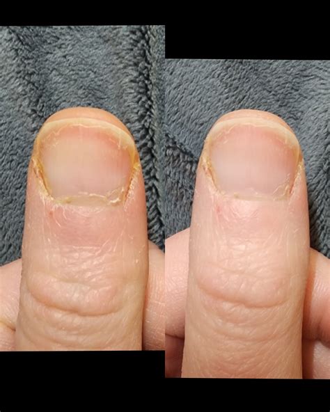 yellow discoloration of 2 fingernails/nail folds developed over 5-7