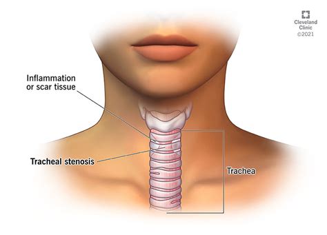 Tracheal Stenosis: Symptoms, Causes & Treatment