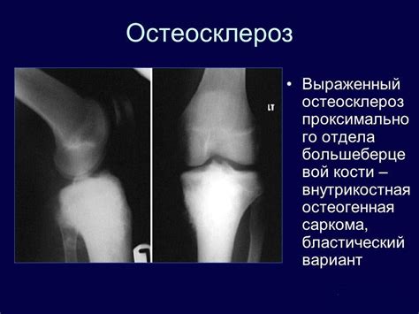 Остеосклероз коленного сустава: что это такое, причины, симптомы и ...