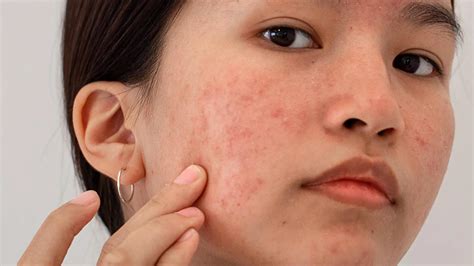 pcos skin symptoms hirsutism endocrine society