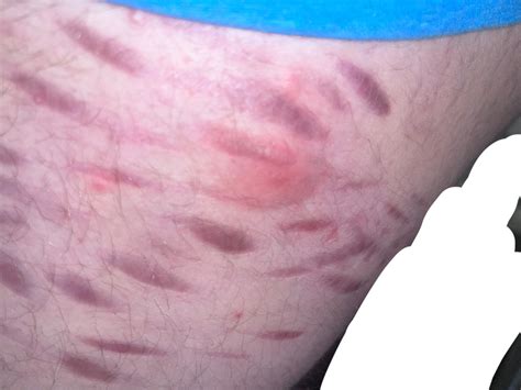Boil/ skin abscess infected? TW old scars : r/DermatologyQuestions