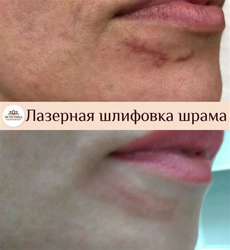 Лечение рубцов и растяжек