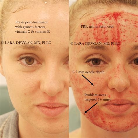 What Is Microneedling And How Does It Work Apderm | My XXX Hot Girl