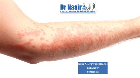 Skin allergy treatment in vikaspuri Tilak Nagar Janakpuri Rajouri Garden