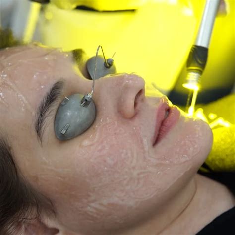 gold laser  aivee group