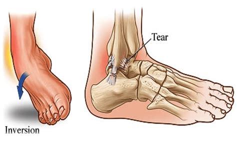 A Guide to Ankle Sprains | Hurst Podiatry
