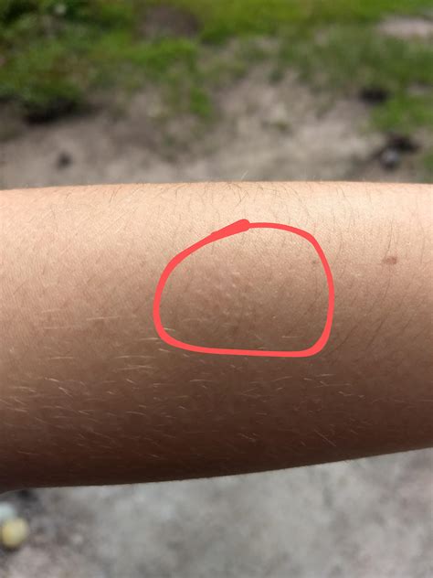 So, I have bumps on both of my arms that are similar to goosebumps