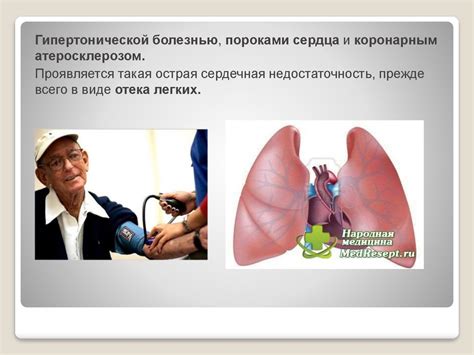Острая левожелудочковая сердечная недостаточность - презентация онлайн