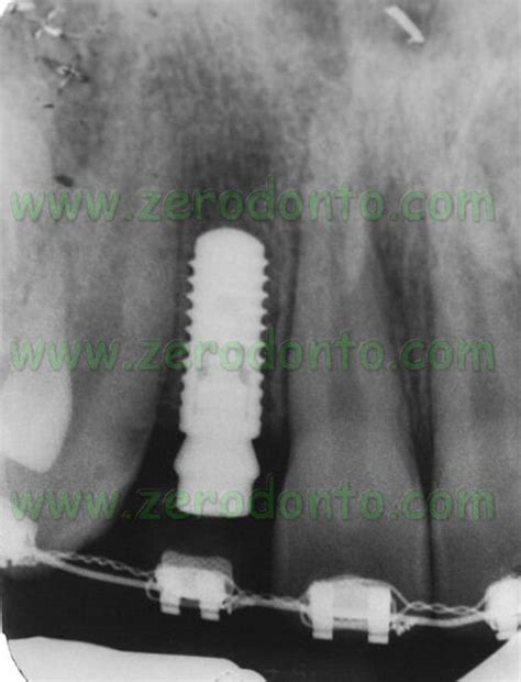bone level straumann implants zerodonto dentistry  blog